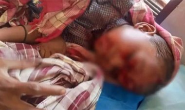 बालोद में कुत्ते का आतंक: 4 साल के मासूम पर हमला, 17 गंभीर जख्म