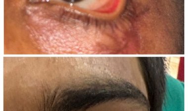 स्किन ग्राफ्टिंग से मरीज के पलक का सफल पुनर्निर्माण