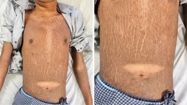 छत्तीसगढ़ में 19 साल के युवक में मिली दुर्लभ बीमारी, डॉक्टर भी हैरान